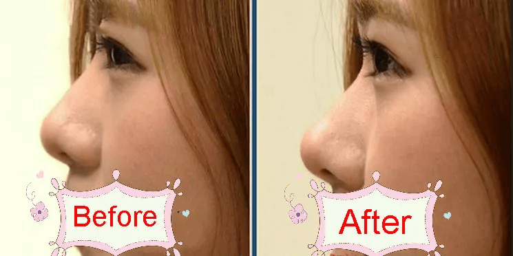 Adjustable Nose Up Lifting and Shaping Clip, Nose Slimming Beauty Tool Set Clipper Shaper for Natural Nose Reshaping