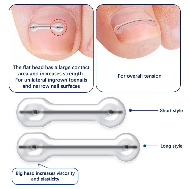 Foot Care Ingrown Toenail Correction Kit