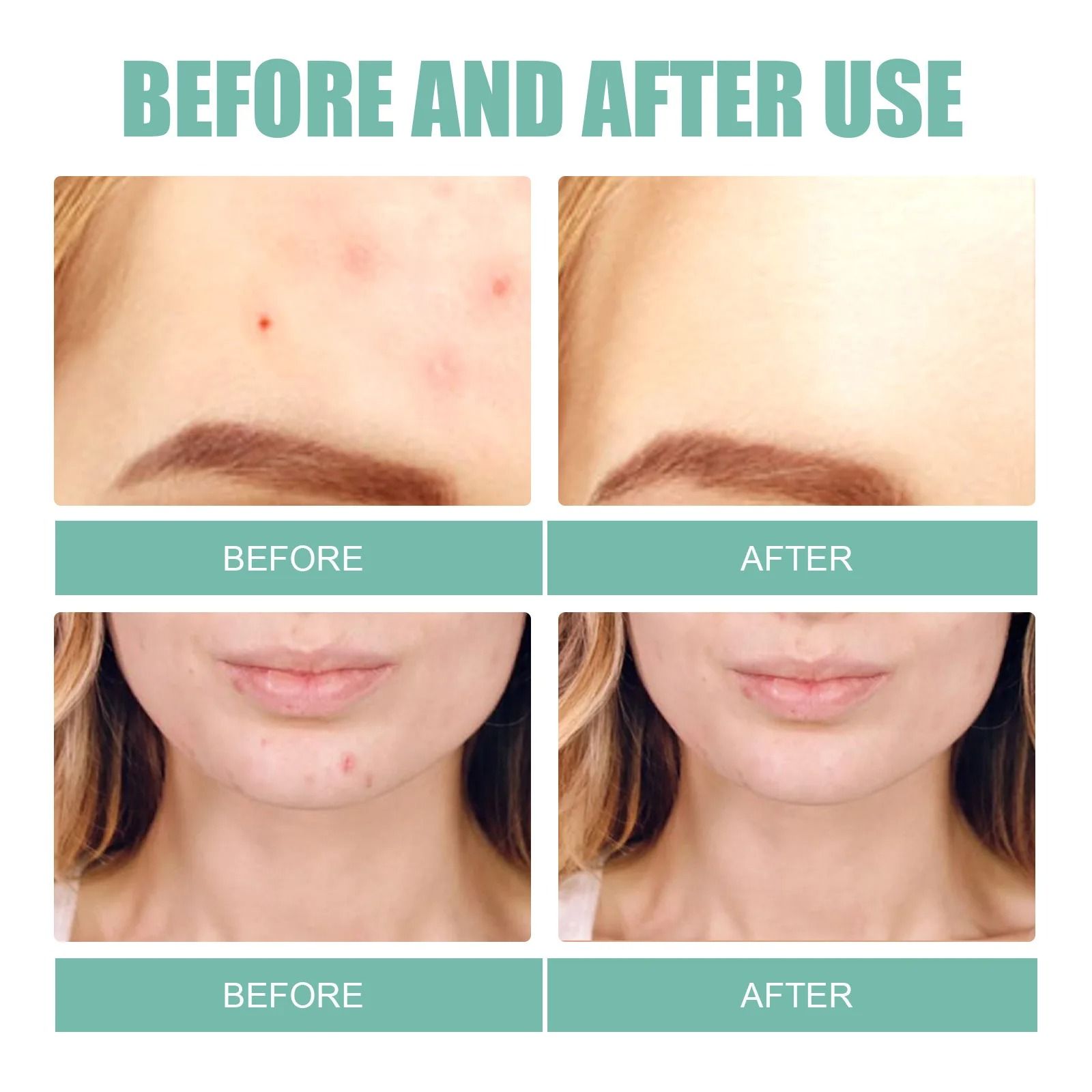 Acne Pimple Patches 132 PCS Hydrocolloid Invisible Skin Care Stickers
