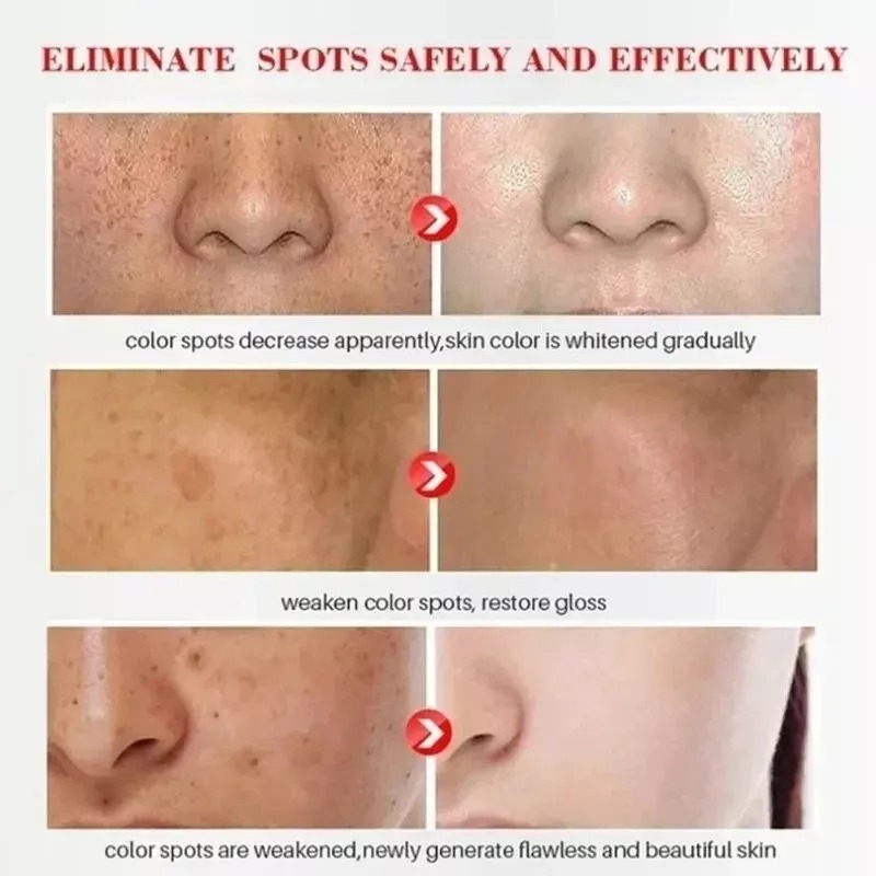 Effective Whitening Freckle Cream Remove Dark Spot Cream Removal Melanin Melasma