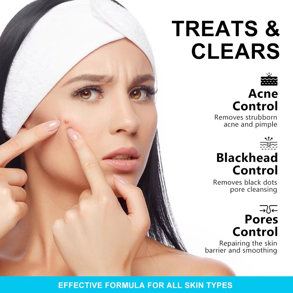 AUQUEST Salicylic Acid Acne Face Cream – Pore Refining & Blackhead Removal Niacinamide Moisturizer