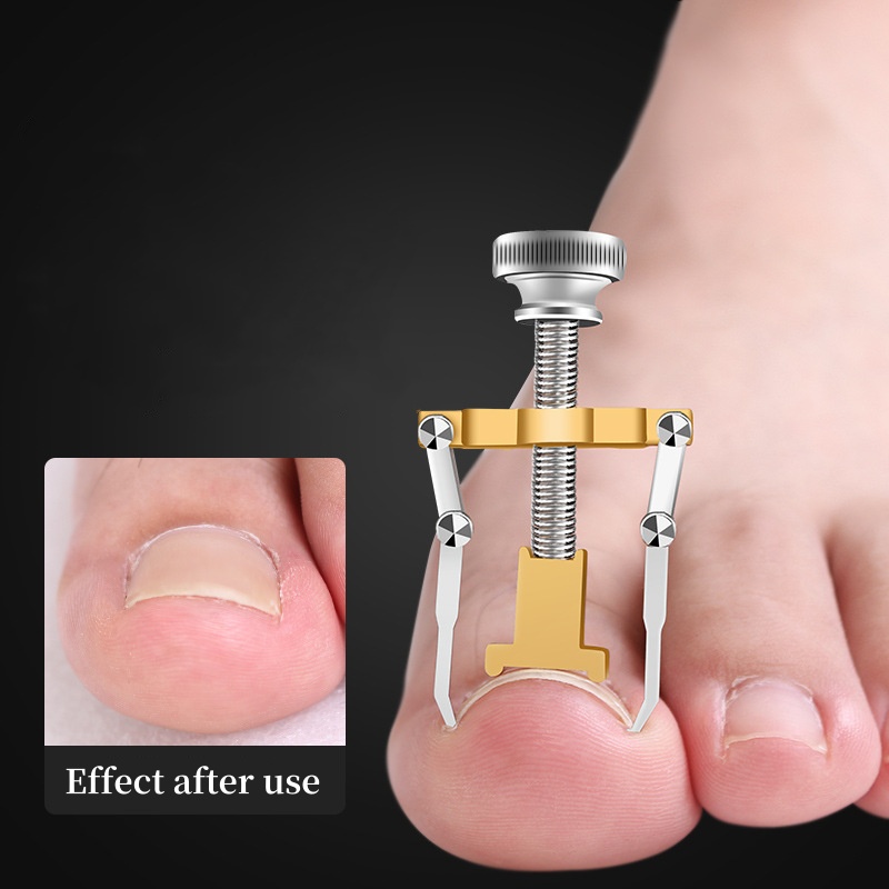 Stainless Steel Ingrown Toenail Lifter, Nail Straighten Clip, Paronychia Corrector Foot Care Tool