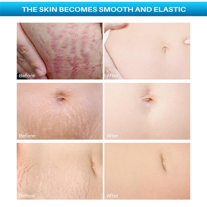 Postpartum Repair Essential Oil, Fade Stretch Marks Fat Lines, Big Belly Recovery Body Massage Oil Skin Whitening Care
