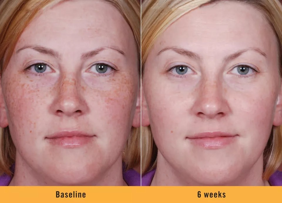 Kojic acid skin whitening lightening ultra brightening serum dark spot cream
