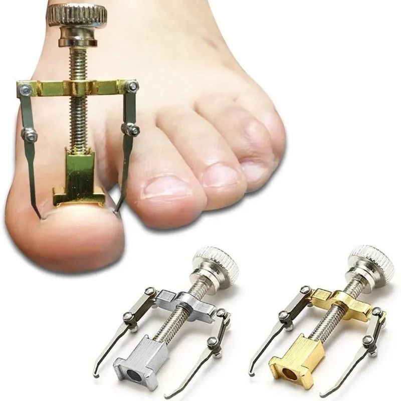 Toenail Correction Bracket Tool for Ingrown Nail Treatment and Paronychia Care
