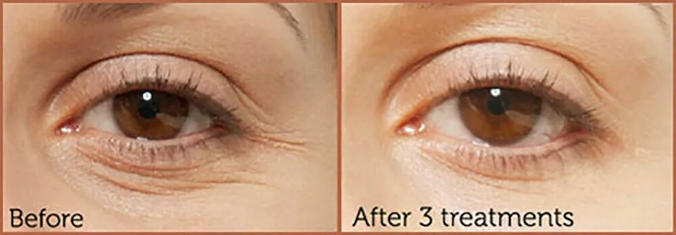 Matrixyl 3000 60% & hyaluronic acid ha Serum Anti Aging Wrinkle