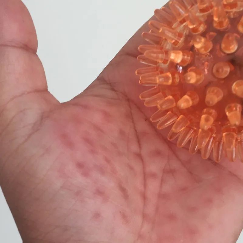 Spiky Massage Stress Ball for Hand & Wrist Therapy, Soft Hollow Grip Strength Recovery Ball for Exercise & Relief