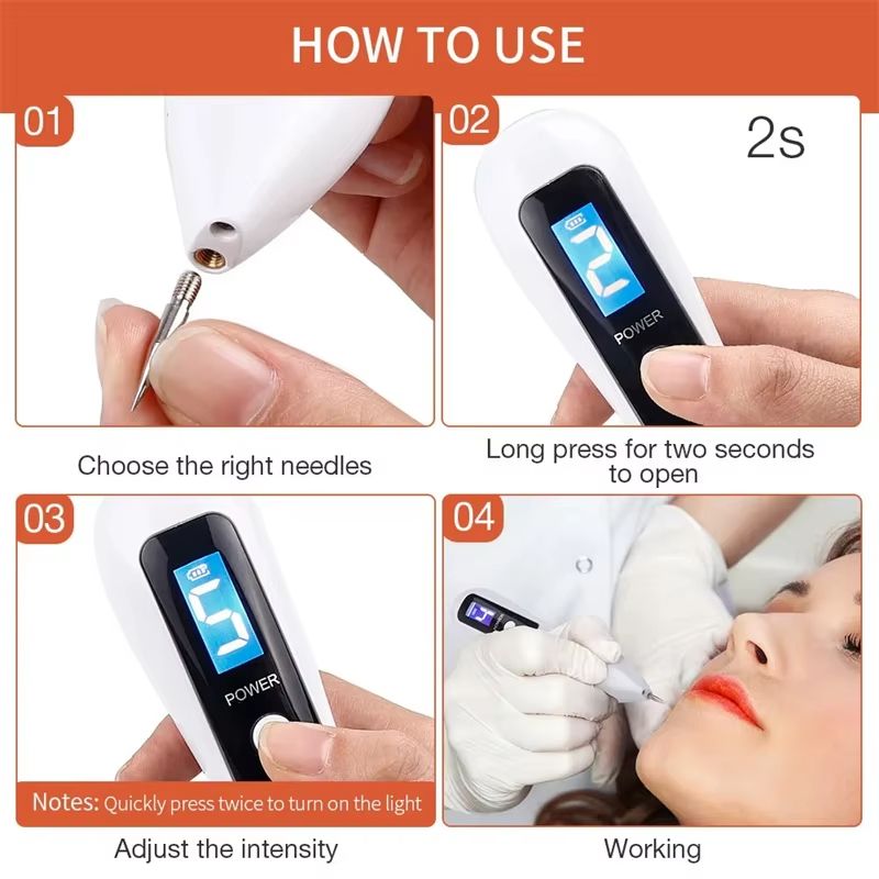 UBilli Plasma Beauty Pen – Laser Skin Tag Remover, Freckle & Tattoo Removal Tool for Spot Care