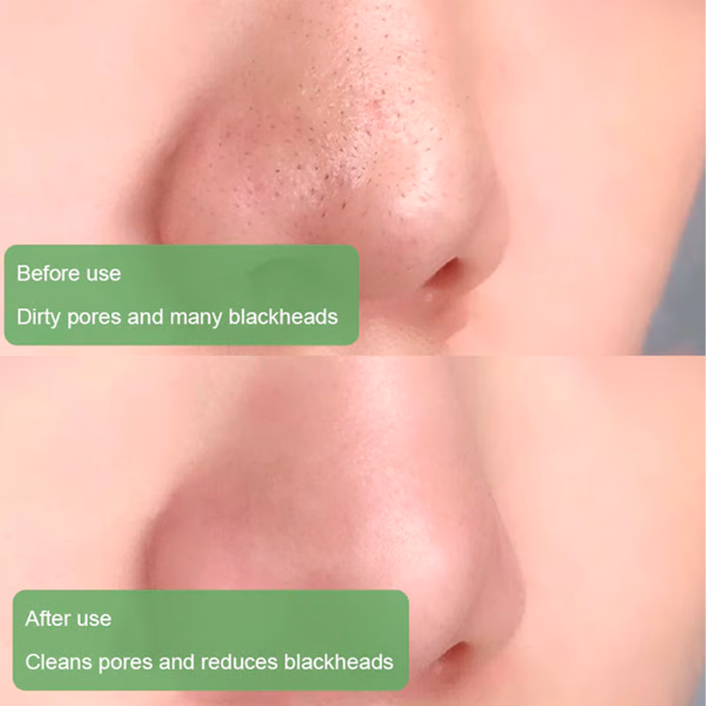 Anti-Acne Blackhead Remover Green Tea Mask