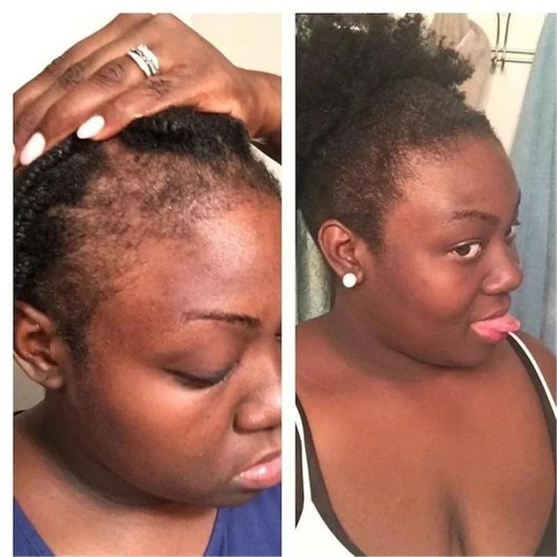 Rosemary Onion Hair Growth Shampoo with Anti-Hair Loss Spray – Fast Hair Regrowth in 7 Days