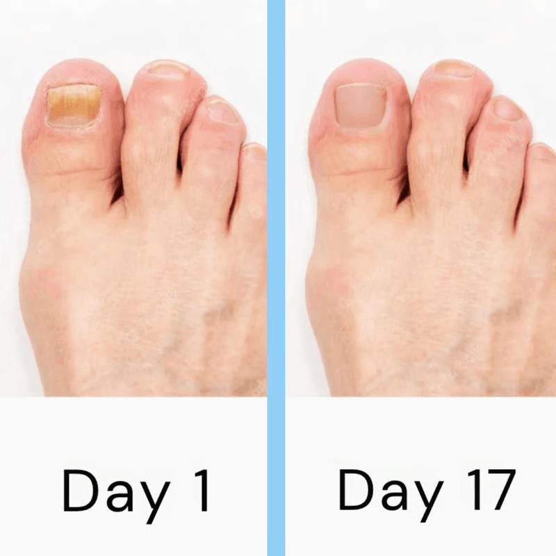 Nail Fungus Laser Therapy Device, Safe, Painless At-Home Nail Care