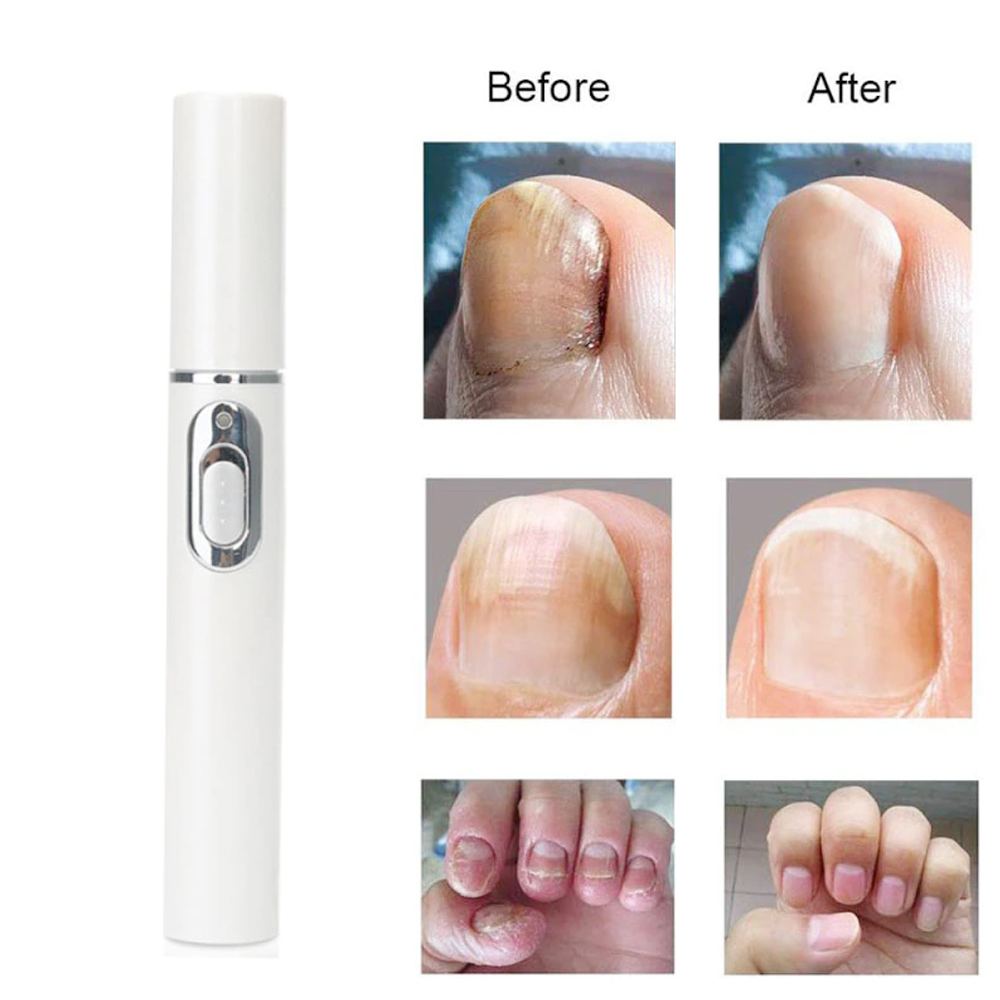 Anti Fungus Laser Pen