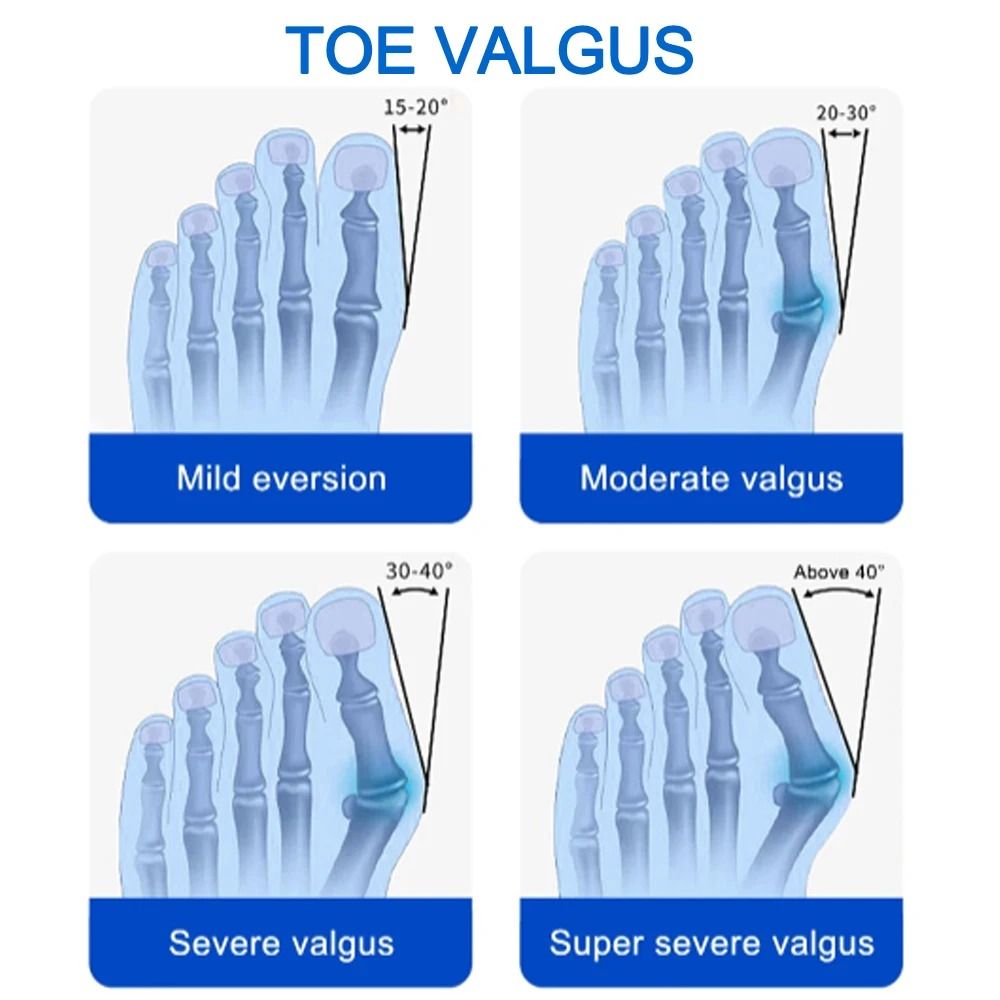 Bunion Splint Big Toe Straightener Orthopedic Foot Corrector for Hallux Valgus Pain Relief