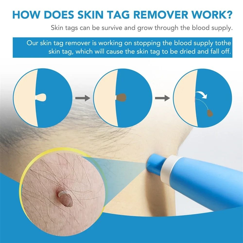 2 IN 1 Auto Micro Skin Tag Remover Device Standard and Micro Removal Kit