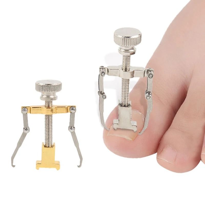 Toenail Correction Bracket Tool for Ingrown Nail Treatment and Paronychia Care
