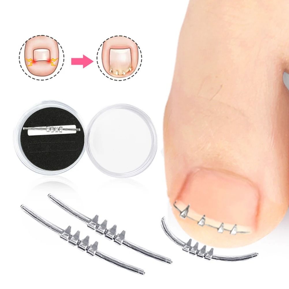 Ingrown Toenail Corrector – Precision Leverage Pedicure Tool for Curvature Correction