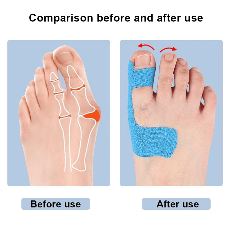 Bunion Corrector Kinesiology Tape for Toe Alignment and Pain Relief