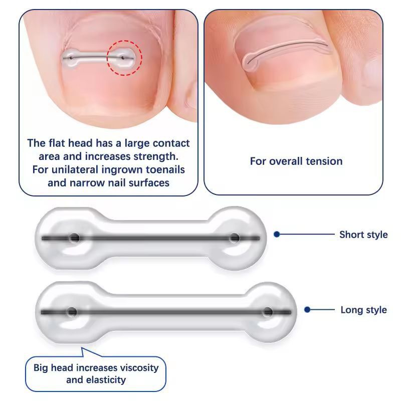 Precision Ingrown Toenail Correction Patch Set – Professional Toe Brace & Treatment Tool