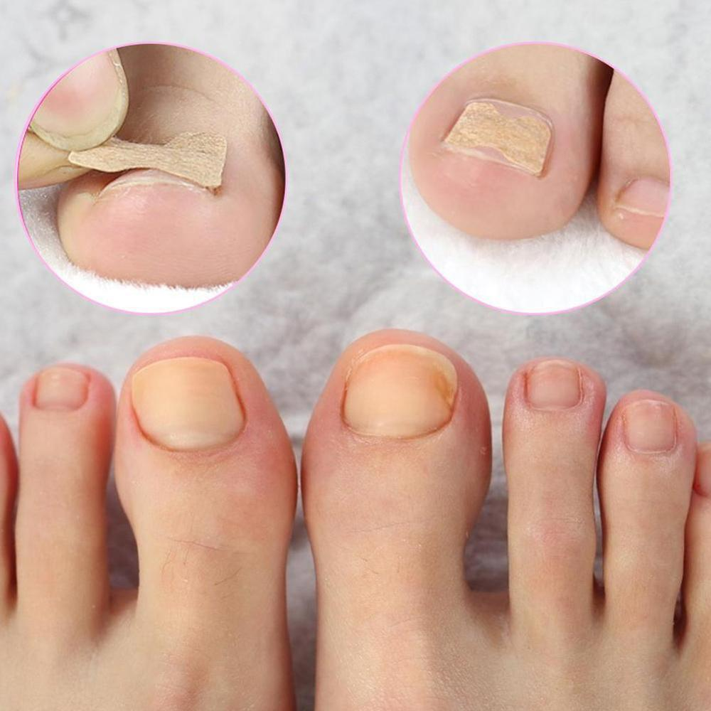 Toenail Corrector Patch (30 Pack) – Pain Relief & Nail Correction | Ideal Foot Care Gift
