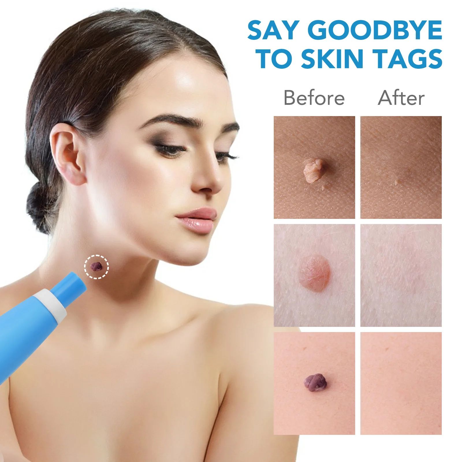 2-in-1 Micro Skin Tag Remover Kit – At-Home skin tag remover & Precision Band Removal Tool