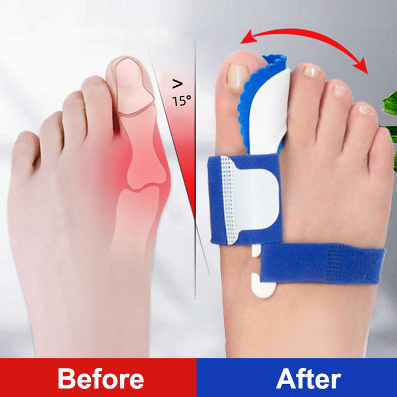Orthopedic Braces Toe Correction, Bunion Device Hallux Valgus, Night Foot Care Corrector Thumb, Daily Big Bone Alignment