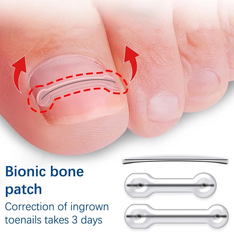 Foot Care Ingrown Toenail Correction Kit