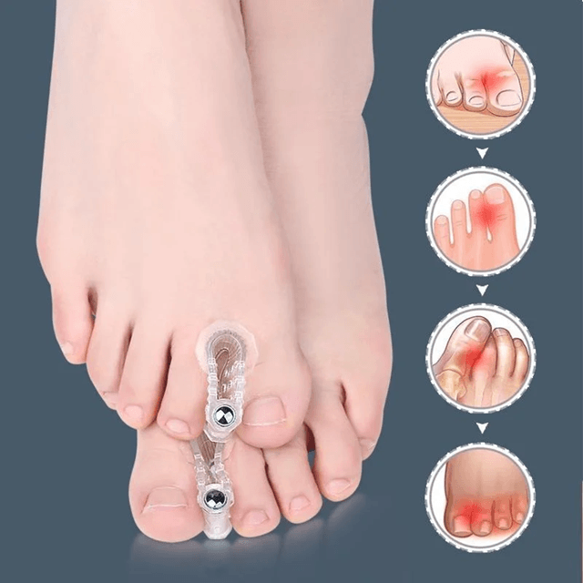 AlignEase Bunion Corrector & Toe Spreader Set – Hallux Valgus Relief Tool