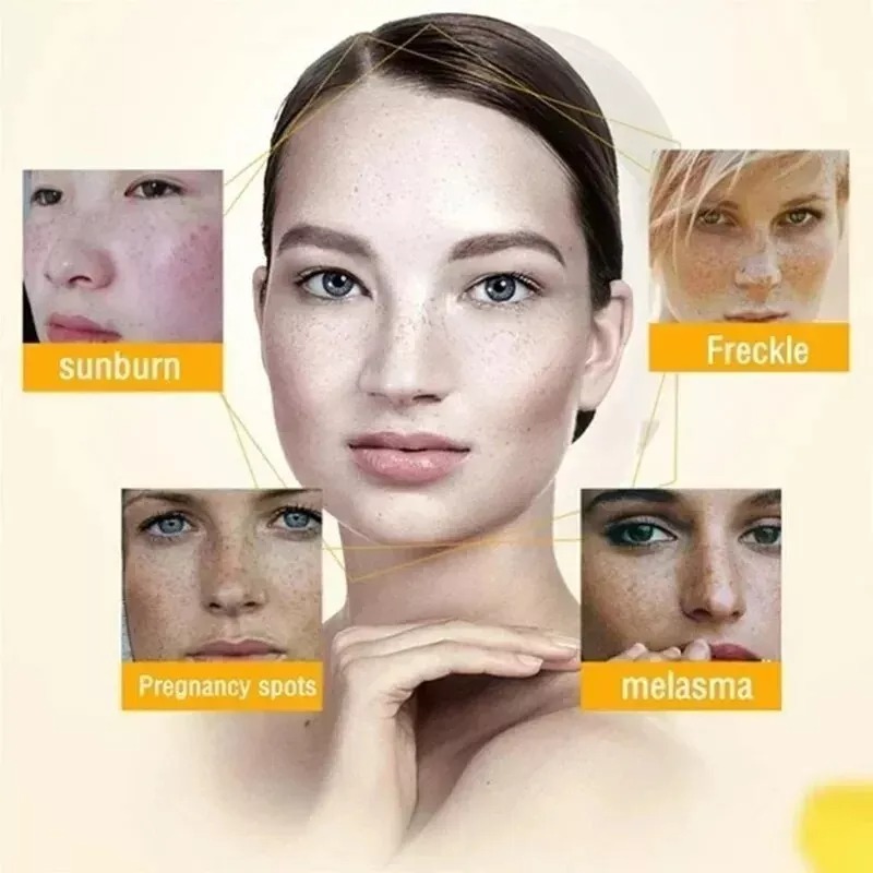 Effective Whitening Freckle Cream Remove Dark Spot Cream Removal Melanin Melasma