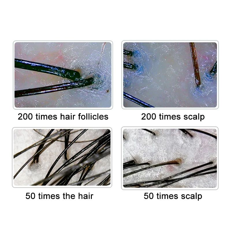 Advanced LCD Scalp Detector Digital Hair Skin Analyzer with Dual-Lens Microscope for Hair Follicle Testing and Skin
