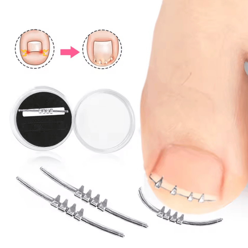 Professional Ingrown Toenail Corrector Tool Curved Clamp Pedicure Nail Straightening Kit