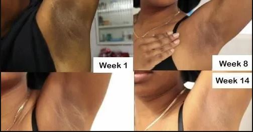 Kojic Acid Skin Whitening Lightening Brightening Serum Bleaching Spot Fade Cream