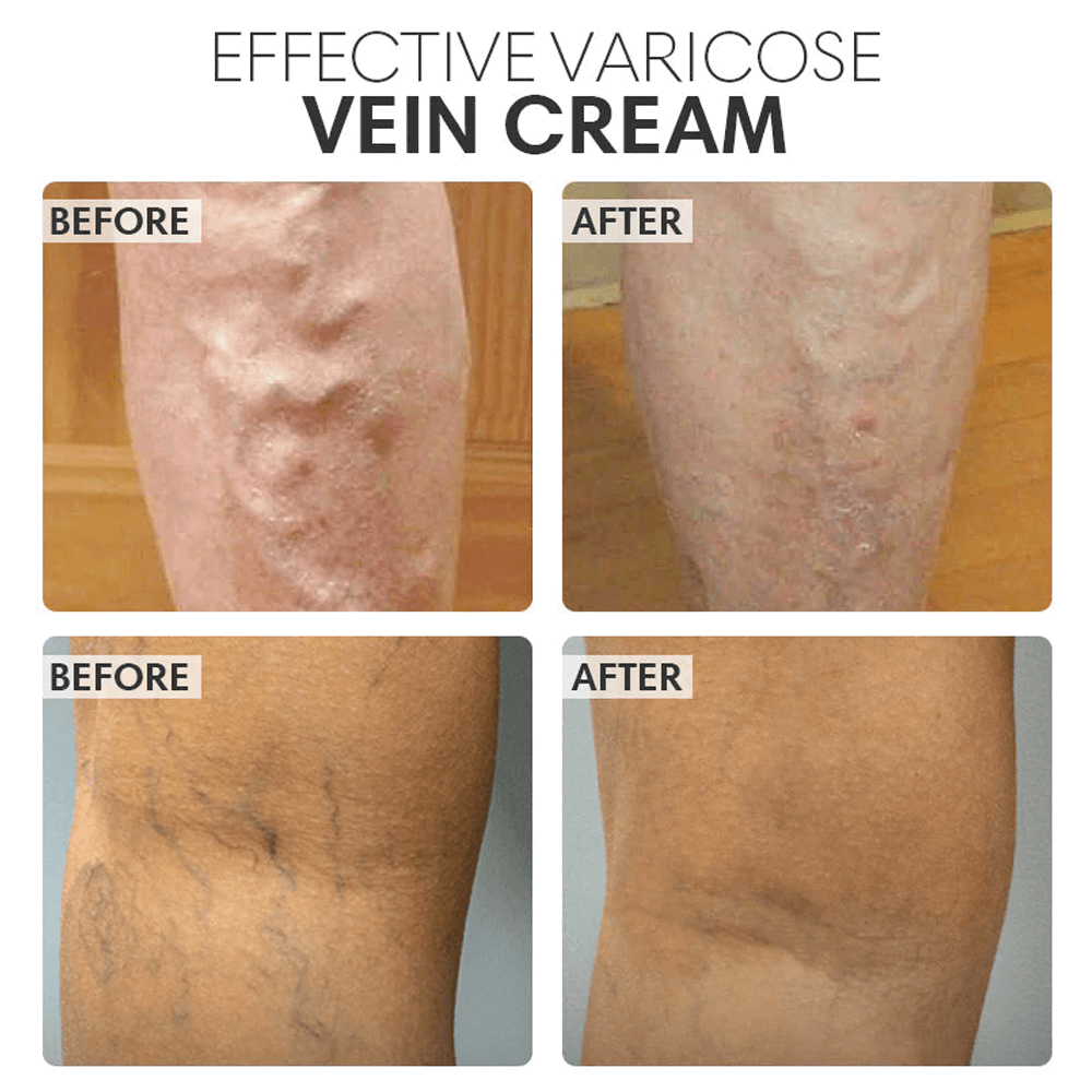 Vein Smoothing Varicose Veins Cream