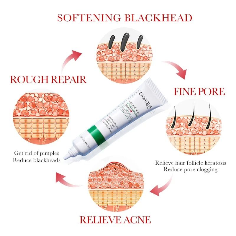 Salicylic Acid Acne Cream for Blackhead Removal and Mark Repair