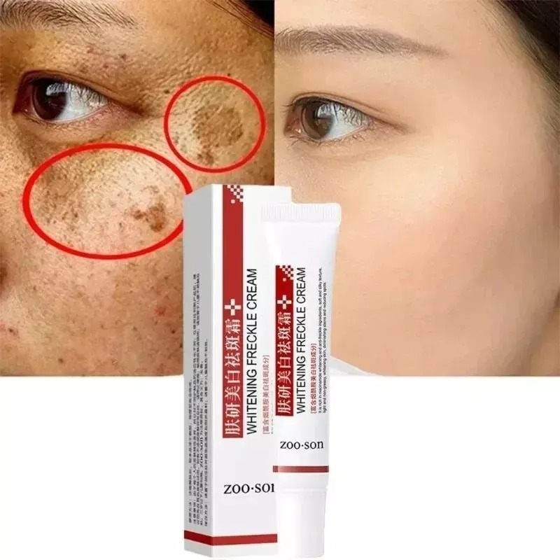 Effective Whitening Freckle Cream Remove Dark Spot Cream Removal Melanin Melasma