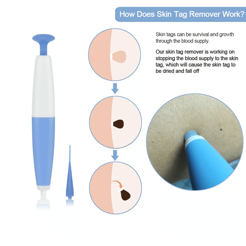 Painless Skin Tag Removal Kit For Safe, At-Home Treatment Without Scars Or Chemicals
