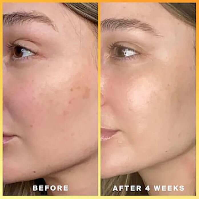 Kojic Acid Skin Whitening Lightening Brightening Serum Bleaching Spot Fade Cream