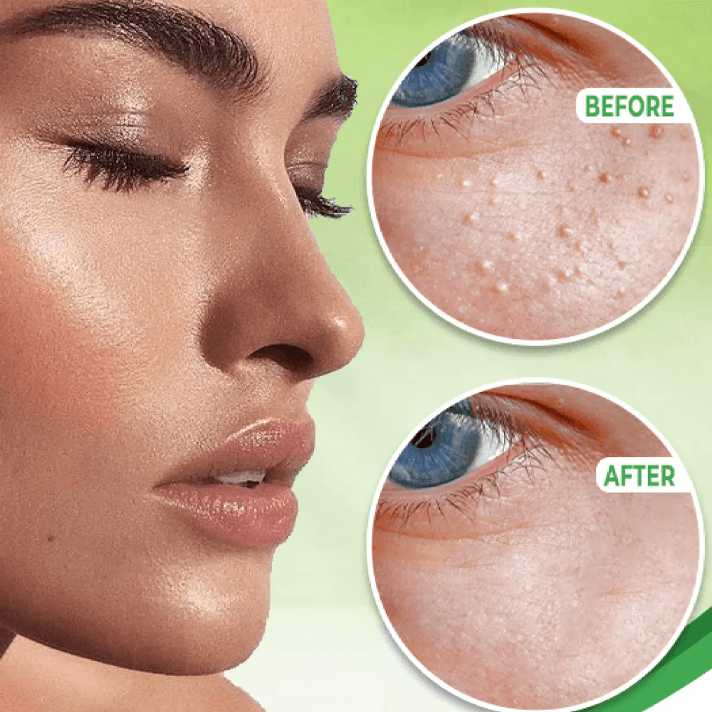 Eye Milia Removal Cream – Ideal Skincare Gift