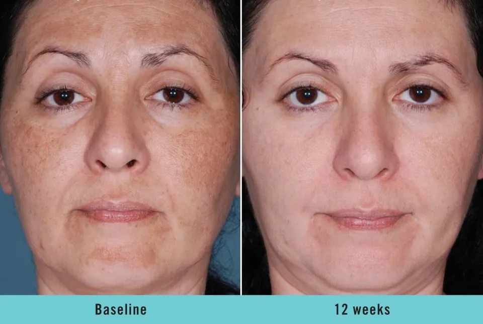 Kojic acid skin whitening lightening ultra brightening serum dark spot cream
