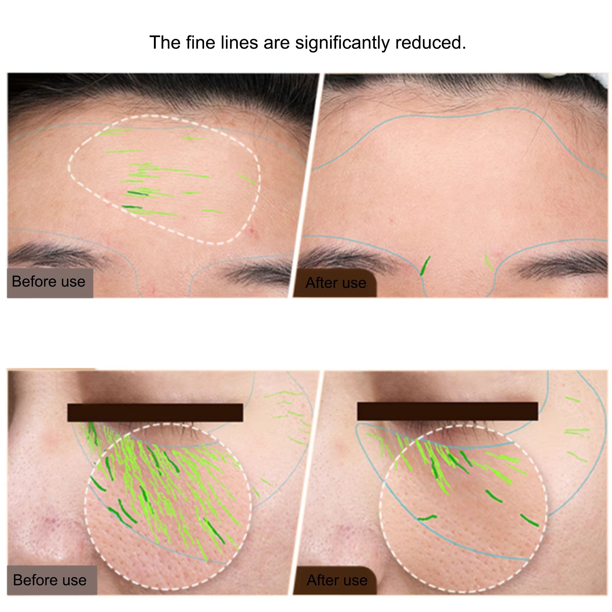Professional RF Skin Tightening and EMS Face Lifting Device – At-Home Anti-Aging Beauty Machine