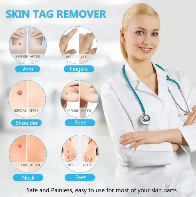 3 in 1 Skin Tag Removal Kit Easy Clean Home Skin Care Tool