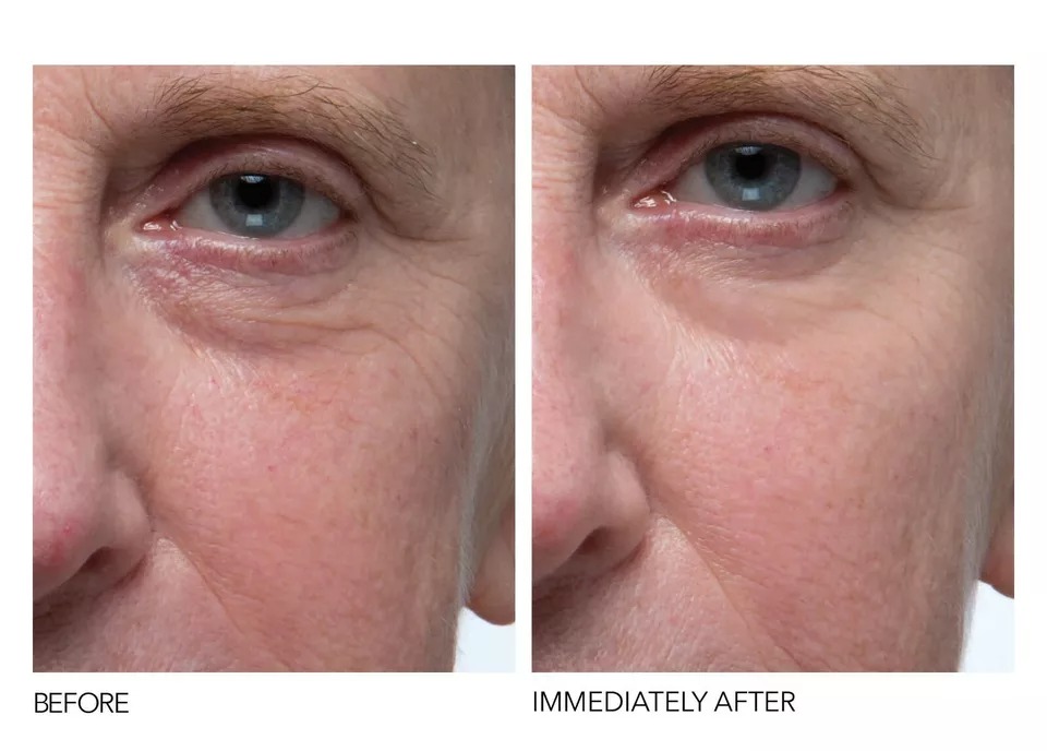 Matrixyl 3000 60% & hyaluronic acid ha Serum Anti Aging Wrinkle