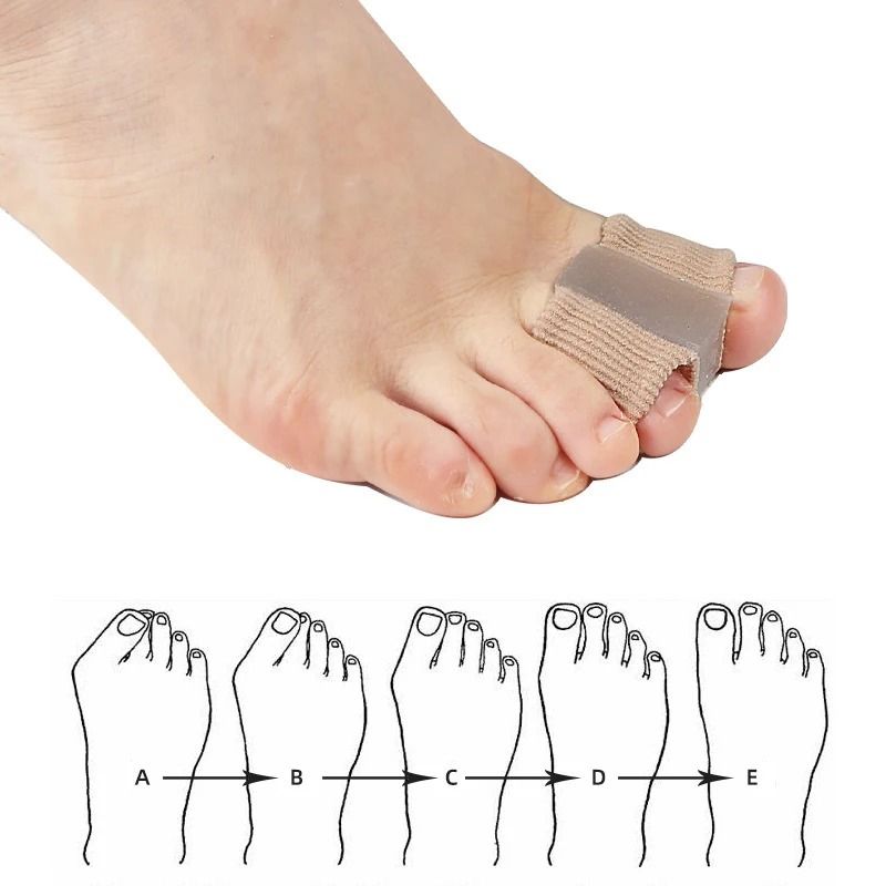 Silicone Toe Separator and Bunion Corrector Gel Toe Spacers for Shoes