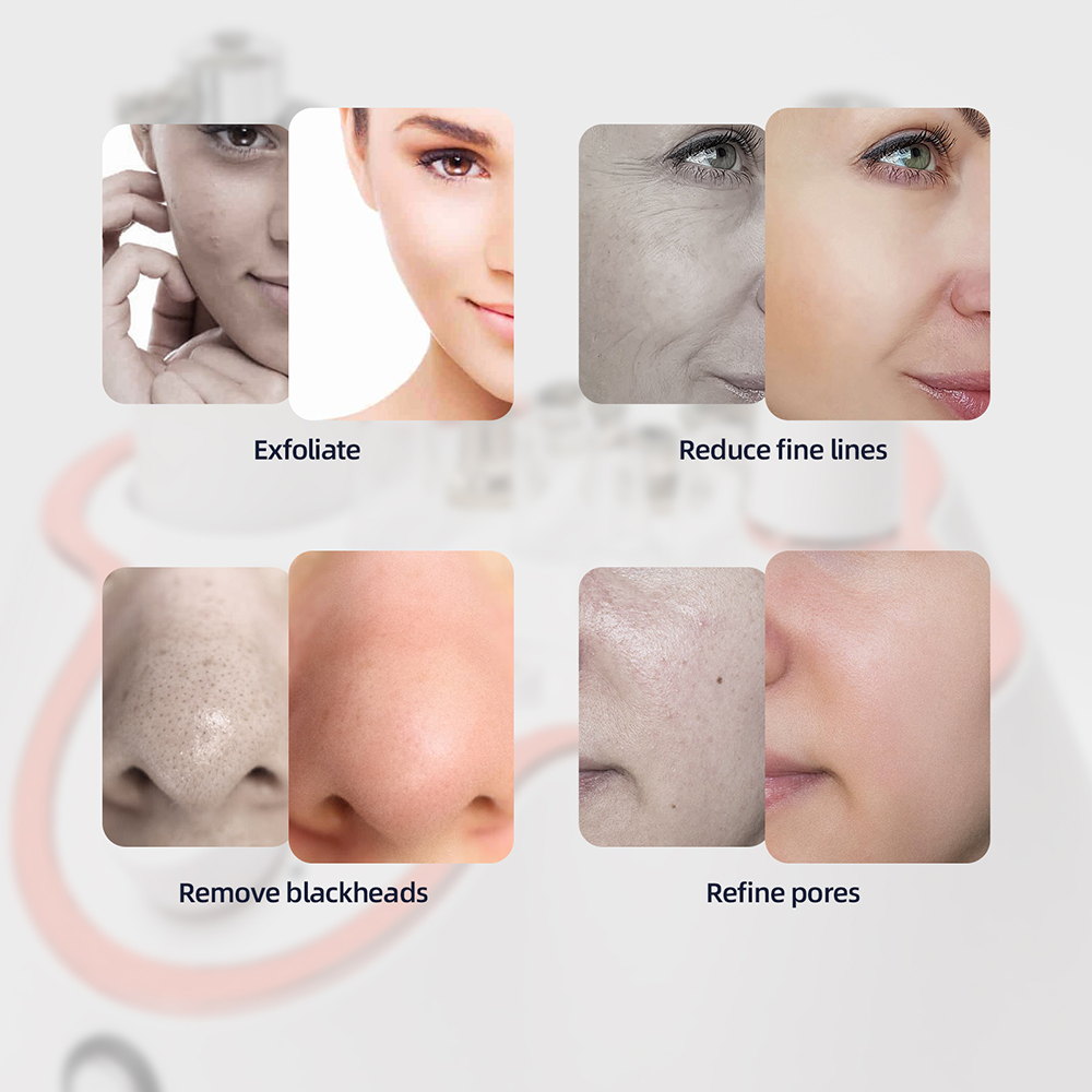 3-in-1 Professional Diamond Facial Peeling Machine, Home Use Professional Microdermabrasion, Exfoliation Beauty Machine