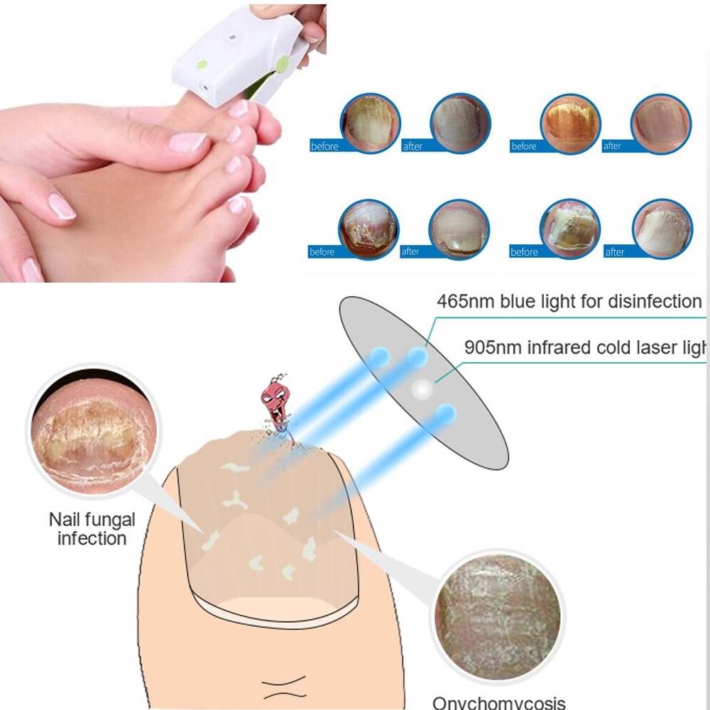 Nail Fungus Laser Device
