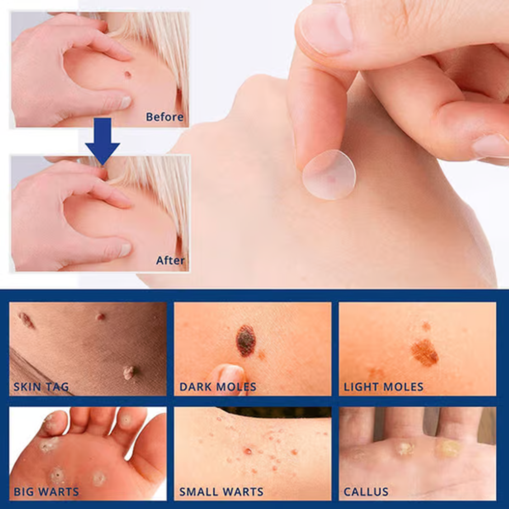 ClearDerm Skin Tag Removal Patch