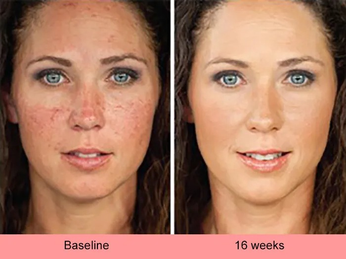 Kojic acid skin whitening lightening ultra brightening serum dark spot cream
