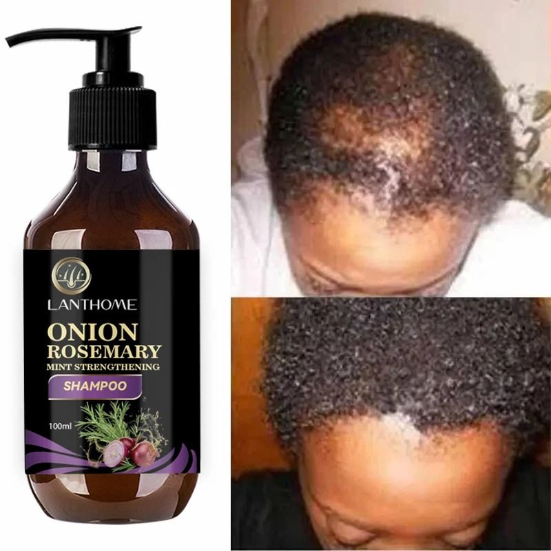 Rosemary Onion Hair Growth Shampoo with Anti-Hair Loss Spray – Fast Hair Regrowth in 7 Days